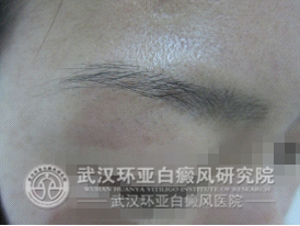 湖北专治白癜风哪里最好