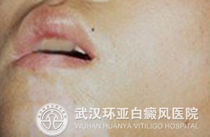 什么原因导致的白癜风 41691402126775.jpg